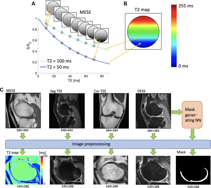 (A, B) Schematic illustrations demonstrate the meaning of the pixel values of a T2 map. (A) Several signals are acquired with different echo times (TEs) by using a multiecho spin-echo (MESE) MRI sequence. When plotted as a function of TE, the intensities of each pixel form an exponential decay curve. The shorter the T2, the steeper the curve. (B) An exponential fit of the form S(t) = Soexp (−t/T2), where S(t) is the measured signal at time t, So is the signal before T2 decay, exp is the natural exponential function, and (−t/T2) is the negative ratio of the measurement time t and the T2 relaxation rate, is performed on the data points, resulting in a T2 value for each point, here drawn on a colored map. The color mapping of two sample points is shown for illustrative purposes. (C) Preprocessing workflow of image data. T2 maps are generated from exponential fitting of the time series MESE data, and the anatomic images are reformatted so that they all have the same spatial resolution, field of view, and image plane. Cor = coronal, DESS = double-echo in steady-state, NN = neural network, Sag = sagittal, S/So = signal with/before T2 decay, TSE = turbo spin echo.