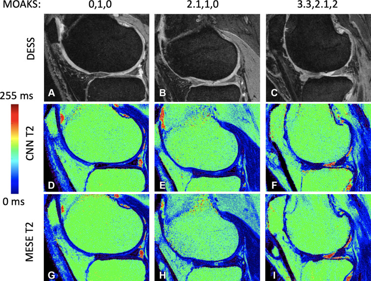 (A–C) Double-echo in steady-state (DESS) images for progressive cartilage degeneration, measured on the lateral femur by using the MRI osteoarthritis knee score (MOAKS). (D–F) Convolutional neural network (CNN) T2 maps corresponding to images A, B, and C, respectively. (G–I) Multiecho spin-echo (MESE) T2 maps corresponding to images A, B, and C, respectively. The MOAKS values listed above the top row of images are defined as the individual anterior, center, and posterior scores, respectively. The scores show any cartilage loss in the respective region; if the patient had full-depth cartilage loss in the region as well, this is added as a separate score after a period. Both scores (the one before the period representing any cartilage loss and the one after the period representing full-depth loss) range from 0 to 3, with 0 representing no loss, 1 representing loss of 1%–10% of the area, 2 representing loss of 10%–75% of the area, and 3 representing loss of more than 75% of the area.