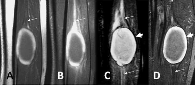 Giant Thrombosed Venous Aneurysm in the Calf: MRI Characteristics and ...