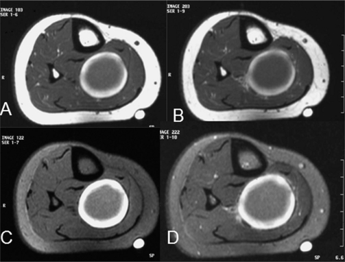 Giant Thrombosed Venous Aneurysm in the Calf: MRI Characteristics and ...