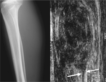 Giant Thrombosed Venous Aneurysm in the Calf: MRI Characteristics and ...