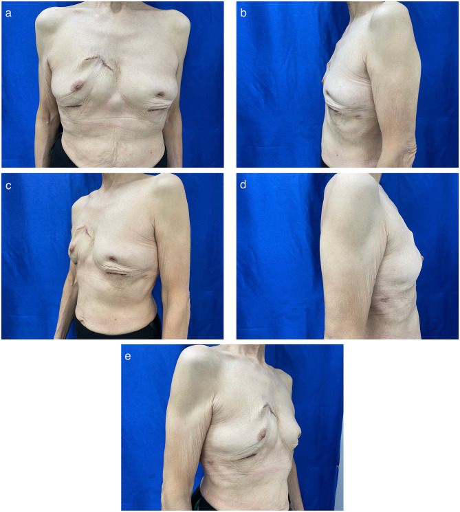 Rupture Of 40 year old Silicone Gel Breast Implants A Case Report PMC rupture-of-40-year-old-silicone-gel-breast-implants-a-case-report-pmc