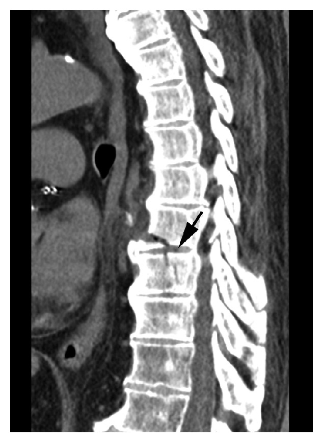 Hemoptysis as the Presenting Clinical Sign of a T8-T9 Spine Fracture ...