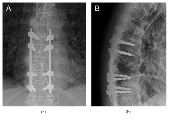 Hemoptysis as the Presenting Clinical Sign of a T8-T9 Spine Fracture ...