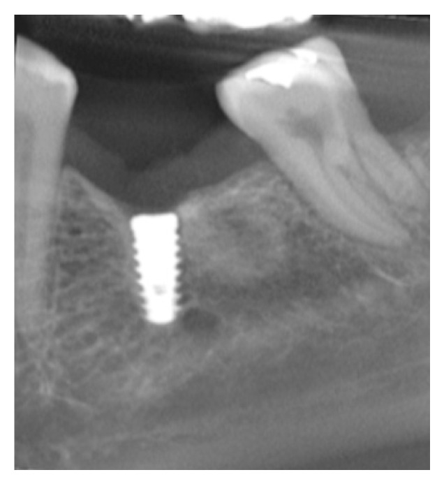 Evaluation Of Behavior Of Castable Versus Machined Solid Abutments For Morse Tapper Implant