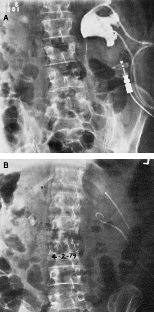 The History of Kidney Stone Dissolution Therapy: 50 Years of Optimism ...