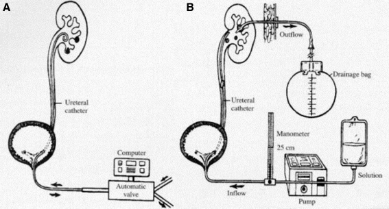 The History of Kidney Stone Dissolution Therapy: 50 Years of Optimism ...