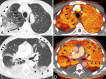 Images in a 69-year-old man hospitalized for fever, weakness, and chills,
found to have coronavirus disease 2019. CT pulmonary angiogram was obtained on
day 4 of admission for acute intermittent tachycardia, desaturation, and new
complaint of shortness of breath. The study was negative for pulmonary emboli.
A, Contrast-enhanced CT pulmonary angiogram of the upper lungs at lung windows
shows a region of peripheral ground-glass opacity and consolidation in the right
upper lobe (arrowheads); the subsegmental vessels within the opacities are
dilated, and the right upper lobe vessels proximal to the opacity are also
dilated (arrows). B, Pulmonary blood volume (PBV) image at the same level shows
a large peripheral perfusion defect corresponding to the distribution of right
upper lobe opacity, with a surrounding halo of increased perfusion (arrows).
There is also heterogeneous perfusion of the left upper lobe. C, CT image of the
lower lungs in the same patient shows peripheral ground-glass opacities and
consolidation in the lower lobes, middle lobe, and lingula with a somewhat round
or wedge-shaped appearance (arrowheads). D, PBV image shows perfusion defects
corresponding to the areas of opacity in C, with surrounding halos of increased
perfusion (arrows).