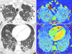 Images in a 45-year-old man who presented with cough and fever, requiring
supplemental oxygen via nasal cannula, and was found to have coronavirus disease
2019. On day 5 of admission, patient underwent CT pulmonary angiography for
acute shortness of breath, tachypnea, and an elevated d-dimer level. A,
Contrast-enhanced CT pulmonary angiogram of the upper lungs shows multiple
ground-glass opacities and consolidation with a peripheral predominance; several
perilobular bands of consolidation suggest an organizing lung injury pattern
(arrowheads). Subsegmental vessels supplying regions of opacity are dilated
(arrows). B, Corresponding iodine map image shows increased perfusion of some
areas of opacity (arrows). C, Axial CT image as part of the same examination
shows additional peripheral ground-glass opacities and consolidation in the
lower lungs, with enlarged vessels within and supplying regions of lung with
opacity (arrows), while vessels in the anterior lungs are smaller in caliber
with relatively lower regional attenuation of the anterior lungs. D,
Corresponding iodine map image shows increased perfusion to the posterior lower
lobes in general, decreased perfusion of the anterior lungs (long arrows), and
small perfusion defects corresponding to posterior areas of opacity seen in C
(short arrows).
