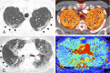 A, B, Images in a 41-year-old man who presented to the emergency
department with acute shortness of breath and underwent CT pulmonary angiography
for concern for pulmonary embolism. Patient tested positive for coronavirus
disease 2019 infection. A, Peripheral ground-glass opacities are present in the
posterior upper lobes (arrowheads); regional dilatation of vessels is noted in
adjacent upper lobes. B, Pulmonary blood volume image at the same level shows
peripheral perfusion defects corresponding to the opacities, with surrounding
halos of increased perfusion (arrows). C, D, Images in a 57-year-old woman who
presented with 7 days of fever, malaise, chills, cough, and increasing shortness
of breath. On day 3 of admission, patient developed increasing oxygen
requirement and elevated d-dimer level. C, CT scan of the upper lungs at lung
windows shows ground-glass opacities in the central and peripheral upper lungs
bilaterally, with regional low attenuation of a portion of the right upper lobe
and superior segment of the right lower lobe (arrowheads). Vessels within the
low attenuation region are diminutive in a regional pattern, while vessels in
the areas of ground-glass opacity are dilated (arrows). D, Corresponding iodine
map image shows regional decreased perfusion to the right lung (white
arrowheads) and increased perfusion to the areas of ground-glass opacity, while
there is also heterogeneous perfusion of the left upper lobe.