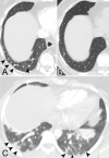A, Image in an 84-year-old woman with a history of breast cancer who
presented to the emergency department for fever, weakness, altered mental
status, acute shortness of breath, and chest pain, for which CT pulmonary
angiogram was obtained. Axial CT image shows dilated, nontapering, tortuous
vessels in the posterior right lower lobe (arrowheads), some of which extend to
the pleural surface. B, CT scan in the same patient shown at the same level 5
months prior shows normal vessels. C, Image in a 27-year-old woman who presented
to the emergency department with acute shortness of breath and dyspnea on
exertion. Patient was subsequently found to be coronavirus disease
2019–positive and had worsening tachypnea. Axial CT image through the
lower lobes shows multiple dilated tortuous vessels within the lower lobes, with
extension to the pleural surfaces (arrowheads).