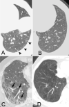 A, B, Images in a 47-year-old woman with a history of metastatic breast
cancer who initially presented with nausea, vomiting, and low-grade fever and
tested positive for coronavirus disease 2019 (COVID-19) infection. Patient
underwent CT pulmonary angiography (CT-PE) on day 4 of admission for acute
intermittent tachycardia, lethargy, and new oxygen requirement. A, Axial CT
image with lung windows through the left lower lobe at time of presentation
shows abnormally dilated distal subsegmental vessels in the subpleural lung
touching the pleural surface (arrowheads). B, Image at the same level of CT in
the same patient 11 days prior shows normal vessel sizes and appearances, with a
normal appearance of the subpleural lung. C, D, Images in a 64-year-old man who
presented with acute onset of fatigue, headache, cough, fever, and shortness of
breath and tested positive for COVID-19. On day 12 of admission, patient
developed increasing oxygen requirement and CT-PE was performed. C, Axial CT
image with lung windows through the right lower lung shows peripheral regional
ground-glass opacity in the right lower lobe, with dilated segmental and
subsegmental vessels supplying the region of opacified lung (arrows) and smaller
diameters of vessels in unaffected lung. D, Image at the same level of a CT scan
in the same patient approximately 3 months prior shows normal appearance of
vessels.
