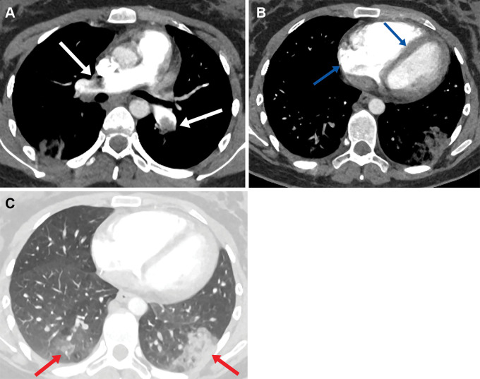 (A) Axial CT pulmonary angiogram image in a 21-year-old woman shows bilateral central pulmonary emboli (arrows) with (B) enlargement of the right heart and flattening of the intraventricular septum in keeping with right heart strain (arrows). (C) Lung window axial CT pulmonary angiogram demonstrates bilateral peripheral areas of opacification in keeping with pulmonary infarcts (arrows).