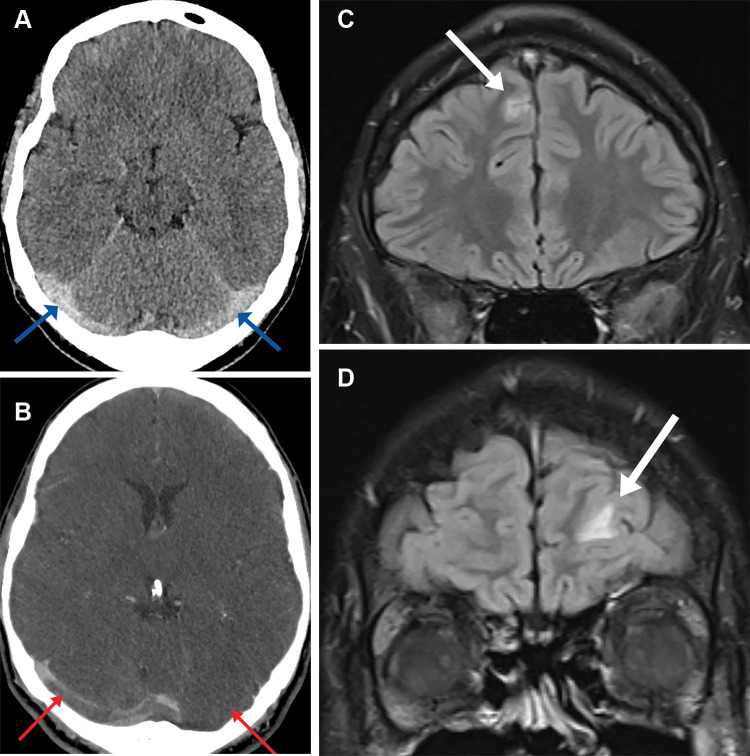 (A) Axial head CT image in a 28-year-old man shows hyperdense bilateral transverse cerebral sinuses (arrows) and (B) axial CT venogram image demonstrates filling defects within the transverse cerebral sinuses bilaterally (arrows). (C-D) T2 coronal fluid-attenuated inversion recovery brain MRI images demonstrate small foci of high T2 sig- nal within the frontal lobes bilaterally thought to represent venous infarcts (arrows).