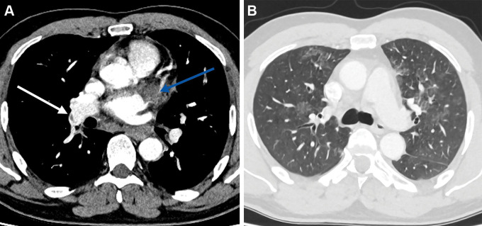 Axial CT pulmonary angiogram images in a 47-year-old man demonstrate (A) a left atrial appendage thrombus (blue arrow) right lobar pulmonary embolus (white arrow), and (B) bilateral ground-glass opacfication.