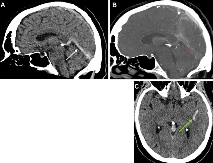 (A) Sagittal head CT in a 54-year-old man shows a hyperdense straight sinus (arrow) confirmed with (B) CT venogram (arrow). (C) Axial head CT shows a 2-cm left temporal lobe cortical venous hemorrhage (arrow).