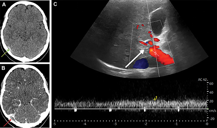 (A) Axial noncontrast head CT in a 27-year-old woman shows a hyperdense right transverse sinus (arrow) confirmed with (B) CT venogram with a filling defect (arrow). (C) Doppler US image shows no flow within the intrahepatic main portal vein in keeping with thrombosis (arrow).