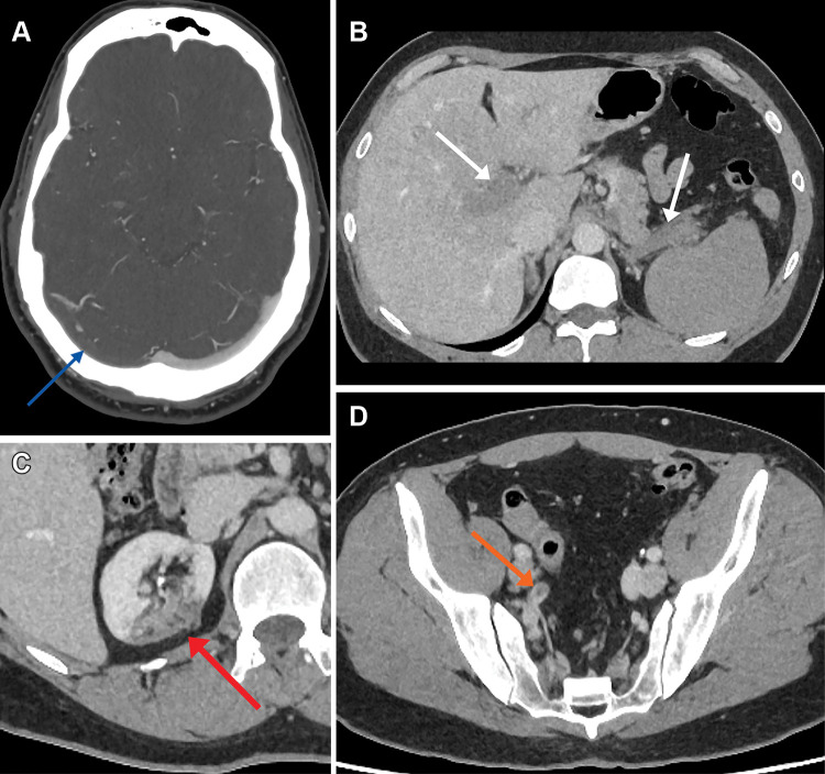 (A) Axial CT venogram image in a 48-year-old man shows a right transverse sinus filling defect in keeping with thrombosis (arrow). (B) Axial portal venous CT of the abdomen and pelvis demonstrates portal vein and splenic vein thromboses (arrows) in addition to (C) right upper pole renal infarct (arrow) and (D) acute right internal iliac artery thrombus (arrow).