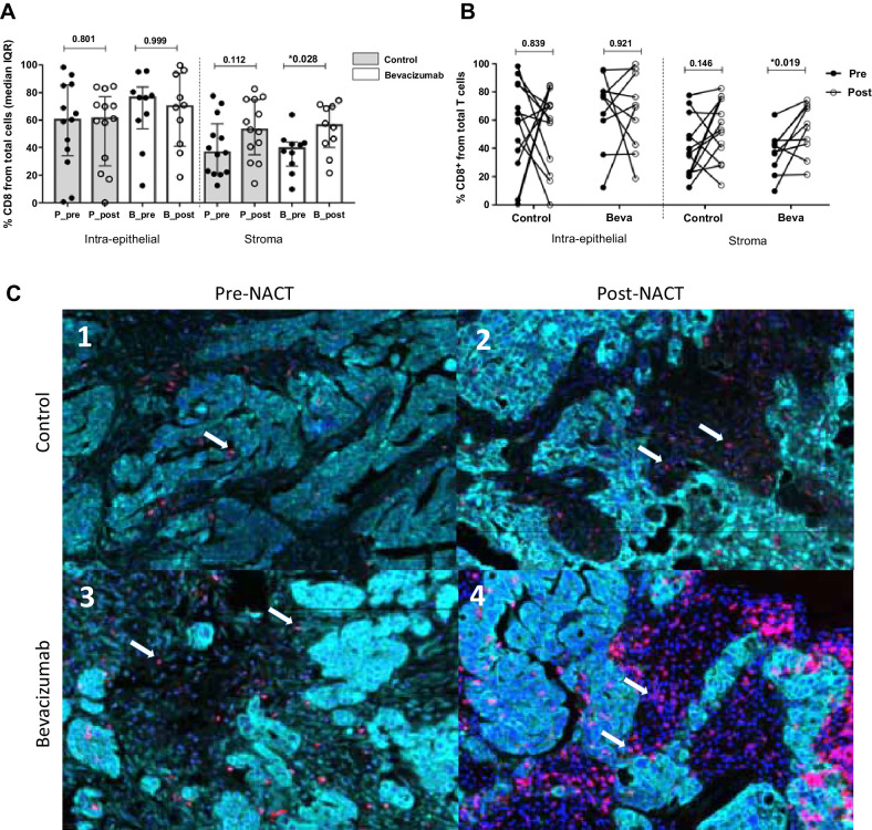 Figure 4. Comparison of CD8+ T-cell immune infiltration at stromal compartment. A, Cellular percentages in CD8+ T present in the different compartments at ovarian cancer sample. Values are given as median and IQR. A significant increase of CD8+ populations is observed in the stromal compartment in the bevacizumab group (P = 0.028, Mann–Whitney test). B, Individual variation from presurgery samples to postsurgery was calculated using the Wilcoxon test, displaying a significant increase over time in the NACT group with bevacizumab (P = 0.019). C, Representative images from multispectral analysis of CD8+ recruitment at tumor and stromal compartment before and after NACT with bevacizumab. In each image, white arrows indicate CD8+ positive cells (Opal 570, red). In the control group, a slight increase is produced after NACT, being very remarkable the infiltration in the bevacizumab group after NACT (c3 vs. C4). The images in our study correspond to four representative patients from each of the study groups (pre-post NACT, control, and bevacizumab group), for the CD4+, CD8+, CD4+FOXP3+ populations present in each of these patients (same patient for different immune cell populations).