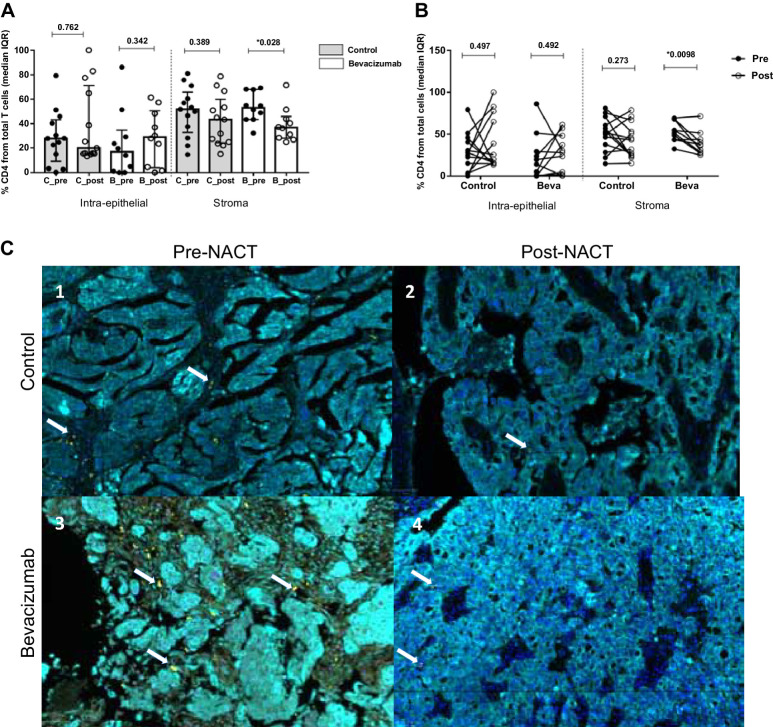 Figure 2. Analysis of CD4+ T-cell immune infiltrates in patients with epithelial ovarian cancer. A, Cellular percentages of CD4+ T cells present in the intraepithelial and stromal compartment. Values are given as median and IQR. Mann–Whitney test was used to compare differences in the general population according to the treatment and the time of surgery. After chemotherapy, helper CD4+ T-cell populations experienced a decrement being statistically significant in the stromal compartment for the bevacizumab arm (P = 0.028) (Imagen c3 vs. c4). B, Differences between pre-NACT (black dots) and post-NACT (white dots) samples were analyzed. Changes in paired match samples were calculated with the Wilcoxon test. The results previously observed in CD4+ Th populations were confirmed in the individual analysis, showing a decrement in the CD4+ subpopulations after chemotherapy (P = 0.0098). C, Representative images of multispectral for CD4+ recruitment at intraepithelial (cytokeratin, Opal 690, blue) and stromal compartment (nuclei, DAPI) before and after NACT with bevacizumab. In each image, white arrows indicate CD4+ positive cells (Opal 520, yellow). The images in our study correspond to four representative patients from each of the study groups (pre-post NACT, control, and bevacizumab group), for the CD4+, CD8+, CD4+FOXP3+ populations present in each of these patients (same patient for different immune cell populations).