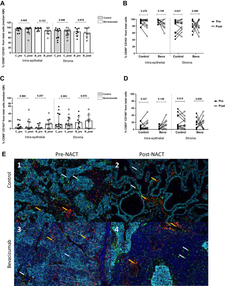 Figure 6. Analysis of TAM markers CD68+ and CD163+ present in patients with ovarian cancer in the intraepithelial and the stromal compartment. A, M1 markers (CD68+CD163−) did not present significant differences between pre- and postsurgery samples in any of the two groups (control and bevacizumab). B, Individual variation from pre-NACT samples to post-NACT was calculated using the Wilcoxon test and confirmed the tendency observed in the total population analysis. C, M2 markers (CD68+CD163+) showed less presence in the intraepithelial compartment than in the stroma, with no differences by experimental arm or time at surgery. D, Individual analysis confirmed the results previously obtained in the global population analysis. E, Multispectral images of CD68+ and CD163+ markers in representative samples from placebo (c1–c2) and bevacizumab (c3–c4) experimental groups. In each image, white arrows indicate CD68+ positive cells, whereas orange arrows point to double staining CD68+CD163+ as an M2-like phenotype.