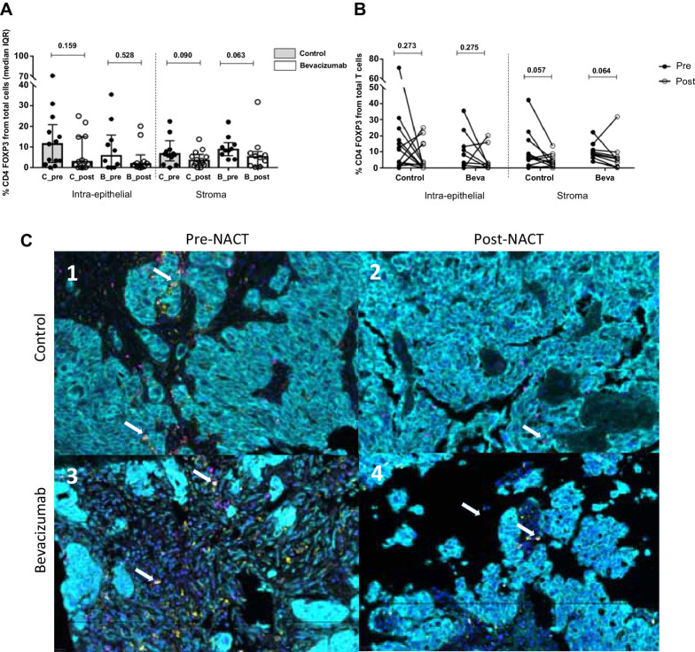 Figure 3. Analysis of CD4+FOXP3+ cells (Treg) in ovarian cancer samples. A, CD4+FOXP3+ (Tregs, double staining) experimented a decrease in both compartments and treatment arms without being significant after NACT. Values are given as median and IQR. B, Differences in paired samples were calculated with the Wilcoxon test, observing the same tendency without being significant: reduction of Treg subpopulations after chemotherapy. C, Representative images of multispectral for CD4+FOXP3+ recruitment at intraepithelial (cytokeratin, Opal 690, blue) and stromal compartment (nuclei, DAPI). In each image, white arrows indicate CD4+ positive cells (Opal 520, yellow) and FOXP3+ (Opal 620, pink). The images in our study correspond to four representative patients from each of the study groups (pre-post NACT, control, and bevacizumab group), for the CD4+, CD8+, CD4+FOXP3+ populations present in each of these patients (same patient for different immune cell populations).