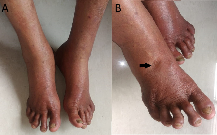 Post Chikungunya Fever and Post COVID-19 Bilateral Pedal Edema: A Case ...