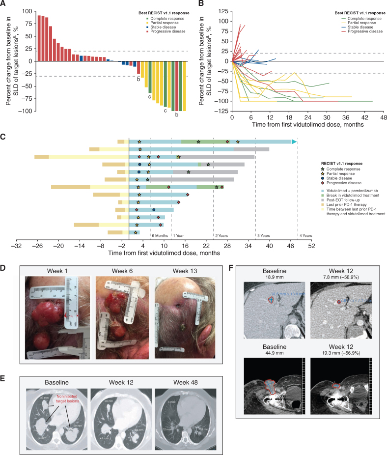 Figure 1. Antitumor activity of vidutolimod plus pembrolizumab. A, Best percent change in SLD of target lesions from baseline. B, Percent change from baseline in SLD of target lesions over time. The bars (A) and lines (B) are colored on the basis of best overall response by RECIST v1.1 as determined by the investigator. C, Duration of vidutolimod treatment, onset, and DOR for each patient with a RECIST v1.1 response (n = 11) and patients with an iRECIST response (n = 2). RECIST v1.1 disease status shown was based on investigator assessment. Representative photographs (D) and radiologic imaging (E and F) demonstrating tumor regression of two injected scalp metastases (D), noninjected visceral lung metastases (E), and noninjected liver (F, top) and groin (F, bottom) metastases from three different patients. aFive patients with missing or incomplete postbaseline disease assessments were not included. bPatients had initial PD per RECIST v1.1 and were later shown to have a PR per iRECIST as determined by blinded central review (n = 2). cPatients with CR had less than 100% target lesion regression (target lymph nodes were less than 1.0 cm in diameter and met the RECIST v1.1 definition of CR). EOT, end of treatment; SLD, sum of longest diameters.