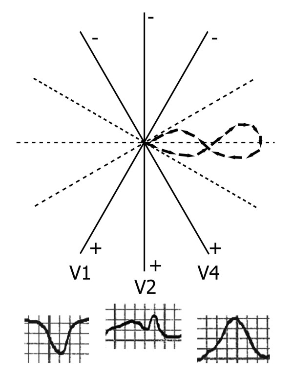 Bifid T waves in leads V2 and V3 in children: a normal variant - PMC