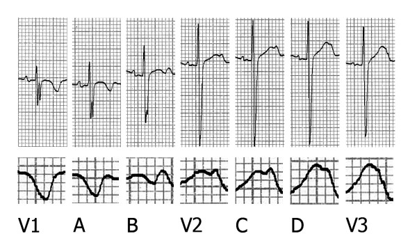 Bifid T waves in leads V2 and V3 in children: a normal variant - PMC