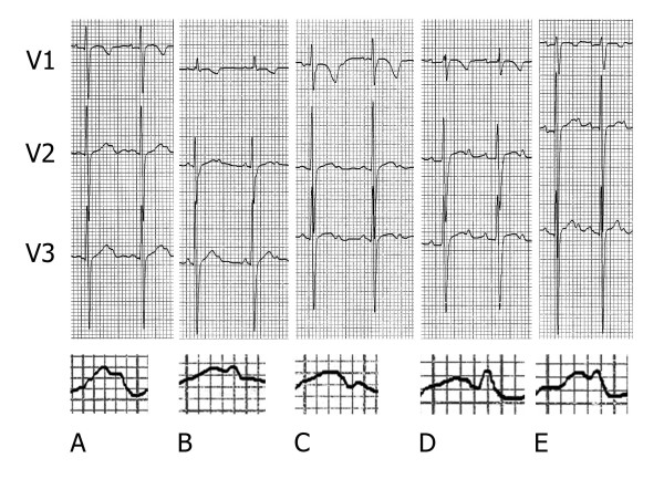 Bifid T waves in leads V2 and V3 in children: a normal variant - PMC