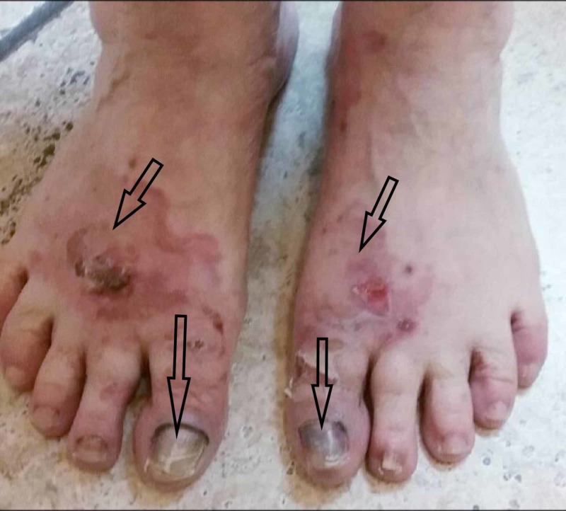 Hydrochlorothiazide vs venlafaxine drug induced bullous pemphigoid pmc
