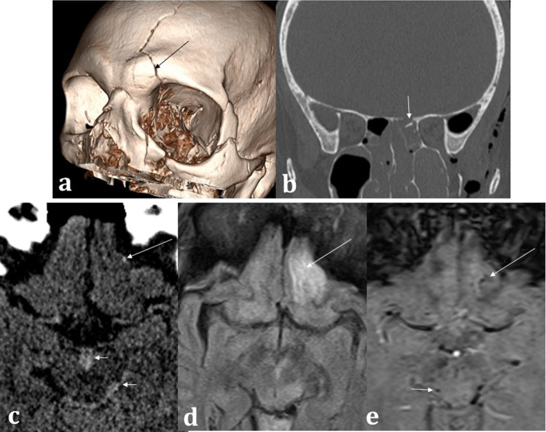 Fig. 14