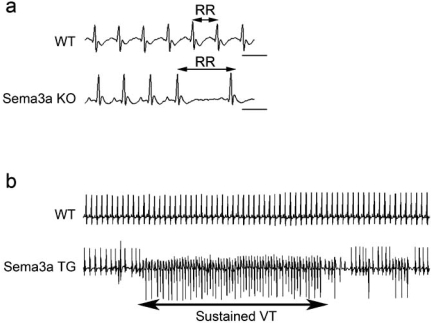 Fig. (4). Various arrhythmias occurred in Sema3a gene-modified mice.