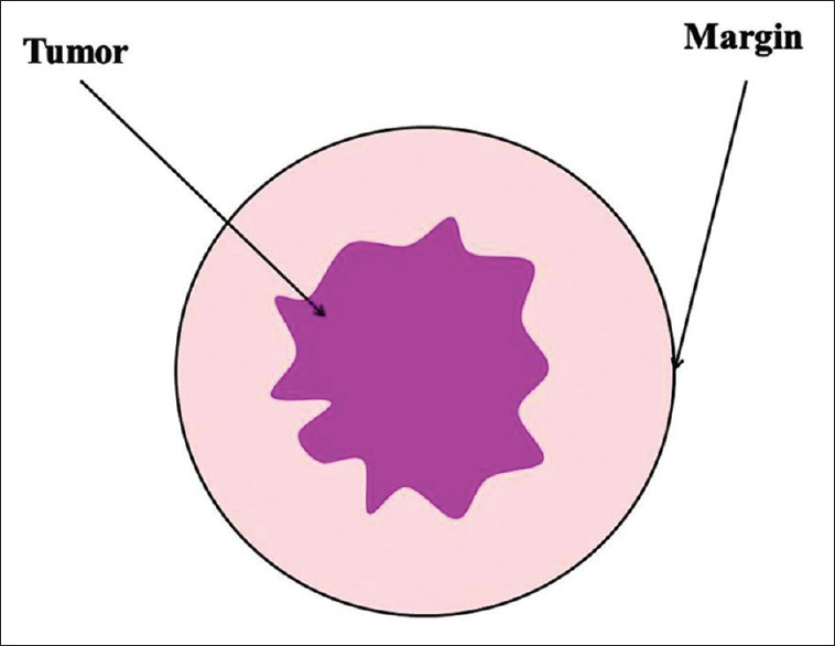 Postoperative pathologic assessment of surgical margins in oral cancer ...