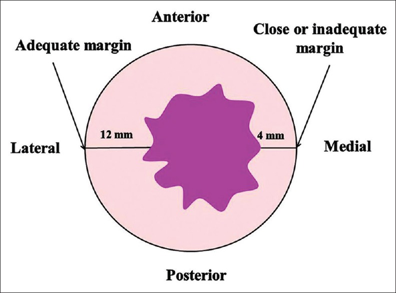 Postoperative pathologic assessment of surgical margins in oral cancer ...