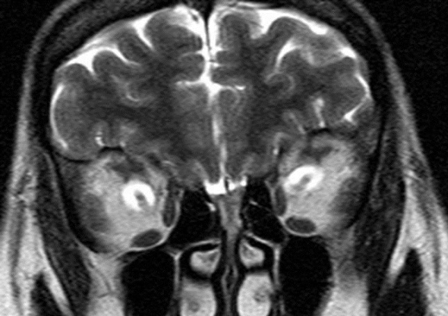 Dural ectasia of the optic nerve sheath - PMC