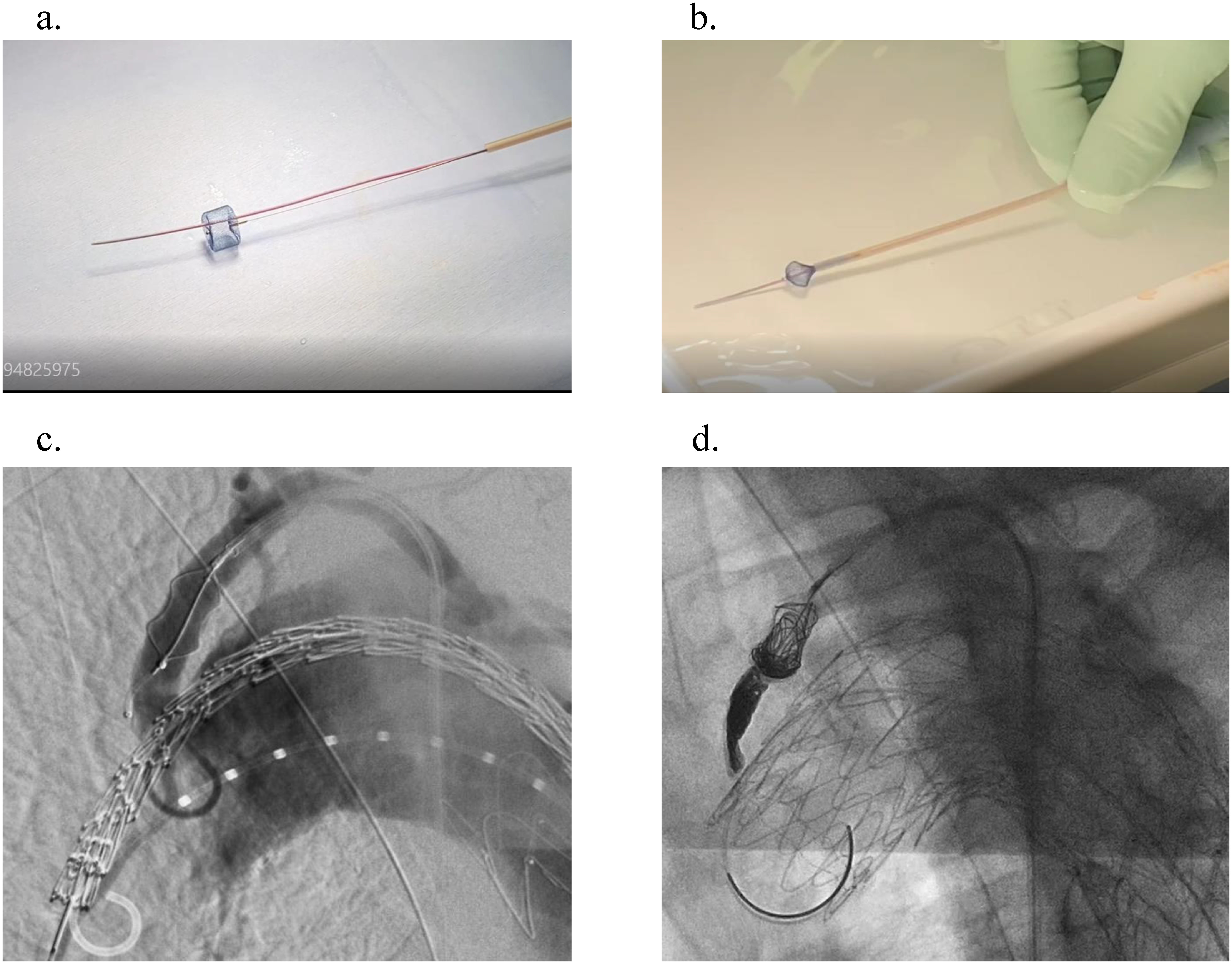 Fig. 1 Coil-in-plug method. (a) Before implantation, the Amplatzer vascular plug I was unfolded from the loader, and a 2.2-F microcatheter was inserted passing through the plug using a 0.016-in guidewire. (b) The plug was stored in the loader in a heparinized saline solution to prevent air from entering the plug. (c) The plug was placed in the left subclavian artery, and the stent graft was delivered to the aortic arch. (d) After deploying the stent graft, a microcatheter was placed through the plug and was embolized between the stent graft and the plug as well as inside the plug.