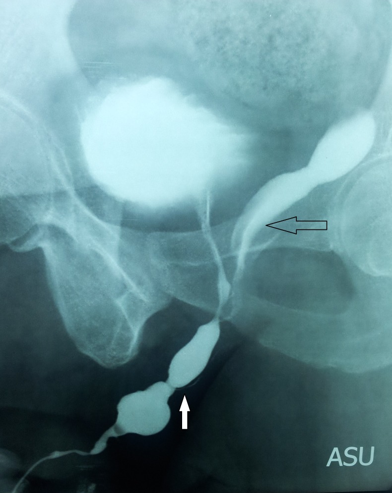 Prostatic Utricle Cyst: A Clinical Dilemma - PMC