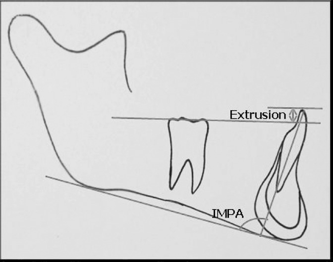 Figure 1. The position of the lower incisor: IMPA and extrusion.