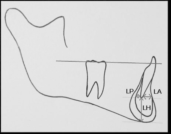 Figure 2. The dimensions of the symphysis: LP, LA, and LH.