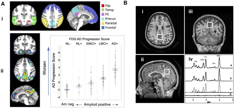 Figure 1 Neuroimaging measures for the study: FDG-PET (left) and 1H MRS (right).