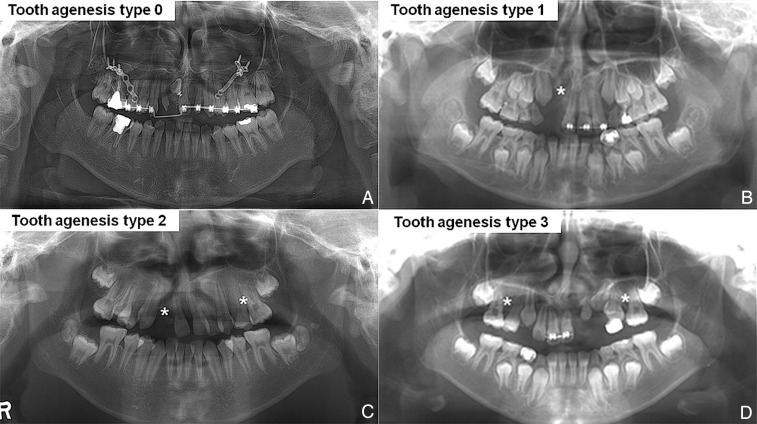 Figure 1. A. Tooth agenesis type (TAT)-0 ‘None (no missing tooth)’ with bilateral cleft lip and palate (CLP) B. TAT-1 ‘Cleft area only [missing of the maxillary lateral incisor (MXLI) within the cleft area only]’ with unilateral CLP. C. TAT-2 ‘Cleft area + Other area (missing of MXLI within the cleft area and another maxillary tooth outside the cleft area)’ with unilateral CLP. D. TAT-3 ‘Other area only (missing of another maxillary tooth outside the cleft area only)’ with unilateral CLP. An asterisk represents a missing tooth.