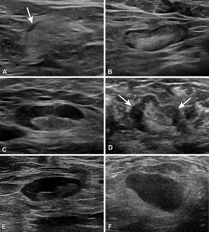 US images of lymph node morphology classified according to the system of Bedi et al (21). (A) Type 1 has a very thin almost imperceptible cortex (arrow). (B) Type 2 has a cortex of 3 mm or less. (C) Type 3 has a diffusely thickened cortex greater than 3 mm. (D) Type 4 has a lobulated cortex (arrows). (E) Type 5 has eccentric cortical thickening or focal lobulation with displacement of the fatty hilum. (F) Type 6 has a completely effaced fatty hilum.