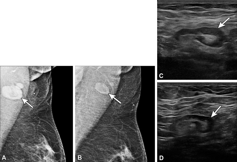 Type 4 lymph node in a 41-year-old woman with no pertinent medical history who presented with palpable concerns in the left axilla 6 days after receiving the second dose of the Pfizer-BioNTech SARS-CoV-2 vaccine in the left arm. (A, B) MLO mammograms of the left breast show axillary lymphadenopathy (arrow in A), which is new from 1 year earlier (arrow in B). (C, D) US images show a type 4 lymph node (arrow in C), which normalized to a type 2 morphology at 6-week follow-up (arrow in D).