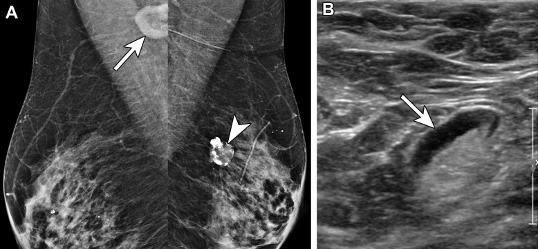 Type 3 lymph node in a 70-year-old woman with right axillary swelling and pain 1 month after receiving the second dose of the Moderna SARS-CoV-2 vaccine in the right arm. In 2005, she underwent left partial mastectomy and chemoradiation therapy for invasive lobular carcinoma. (A) Bilateral MLO mammograms show lymphadenopathy in the right axilla (arrow) and post–partial mastectomy changes in the superior left breast (arrowhead). (B) US image of the right axilla shows a type 3 lymph node (arrow), with cortical thickness of 3–4 mm. The node was considered reactive in the setting of recent COVID-19 vaccination (BI-RADS 2).