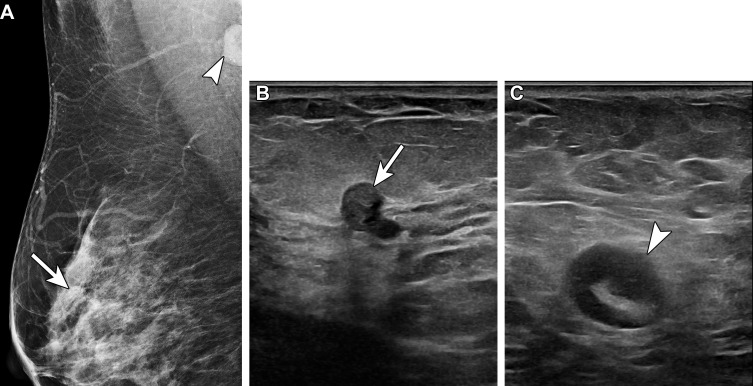 Sclerosing intraductal papilloma and high-grade metastatic carcinoma in a 48-year-old woman who was recalled from routine screening of the right breast for an asymmetry. She received the second dose of the Pfizer-BioNTech SARS-CoV-2 vaccine in the right arm 1 day earlier. In 2020, she underwent left mastectomy for grade 3 invasive ductal carcinoma. (A) Right MLO mammogram shows an asymmetry (arrow) in the superior right breast, 3 cm from the nipple, and an enlarged right axillary lymph node containing several amorphous calcifications (arrowhead). (B) US image of the right breast shows a complex cystic and solid mass (arrow). Biopsy yielded a sclerosing intraductal papilloma. (C) US image of the right axilla shows a suspicious type 5 lymph node with asymmetric cortical thickening of up to 0.6 cm (arrowhead). Biopsy of the lymph node yielded high-grade metastatic carcinoma, consistent with a breast primary.