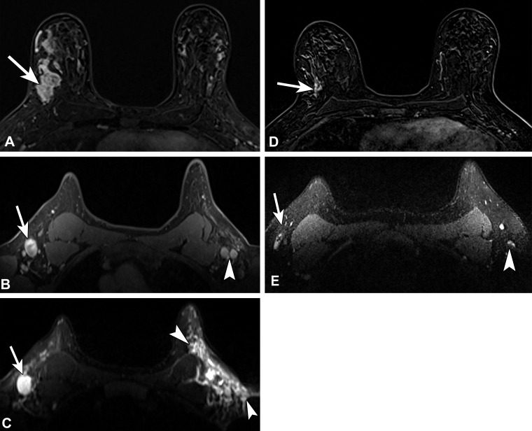 Recently diagnosed invasive ductal carcinoma of the right breast with right axillary nodal metastasis in a 48-year-old woman who presented for MRI for extent of disease evaluation. Three days earlier, she received the first dose of the Pfizer-BioNTech SARS-CoV-2 vaccine in the left arm. (A) Axial contrast-enhanced subtraction MR image shows the known malignancy (arrow) in the right breast. (B, C) Pretreatment axial MR images through the axilla show the known right axillary nodal metastasis (arrow) and left axillary lymphadenopathy (arrowhead in B). On a T2-weighted image (C), there is substantial edema (arrowheads) throughout the left axilla and axillary tail region. US-guided biopsy of an enlarged left axillary lymph node yielded reactive changes. (D) Three-month follow-up axial MR image after neoadjuvant chemotherapy shows decreased extent of disease (arrow). (E) Posttreatment axial MR image through the axilla shows decreased right axillary lymphadenopathy (arrow) and normalized left axillary lymph nodes (arrowhead), as well as resolution of the axillary edema.