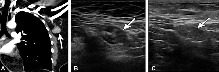 Type 3 lymph node in a 45-year-old woman with no pertinent medical history in whom left axillary lymphadenopathy was incidentally noted at chest CT. One day earlier, she received the second dose of the Pfizer-BioNTech SARS-CoV-2 vaccine in the left arm. (A) Coronal image from chest CT shows an enlarged abnormal-appearing lymph node (arrow). (B) US image of the axilla 2 days later shows a type 3 lymph node (arrow) (BI-RADS 3). Similar morphology was observed at 6-week follow-up (not shown). (C) US image from 12-week follow-up shows a persistent type 3 lymph node (arrow), which was biopsied at the patient’s request and yielded benign lymphoid tissue.