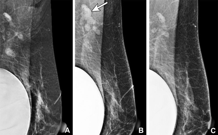 Vaccine-induced axillary lymphadenopathy in a 63-year-old woman with a retropectoral silicone gel implant who underwent screening mammography over 3 different years. (A) Left mediolateral oblique (MLO) mammogram in 2019 shows normal left axillary lymph nodes. (B) Left MLO mammogram in 2021, 2 weeks after she received the first dose of Pfizer-BioNTech SARS-CoV-2 vaccine in the left arm, shows several mildly enlarged superiorly located left axillary lymph nodes (arrow), considered to reflect vaccine-induced lymphadenopathy and assessed as benign (BI-RADS 2). The inferiorly located lymph nodes are unchanged. (C) Left MLO mammogram in 2022 shows normalization of the left axillary lymph nodes.